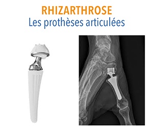 protheses-articulees_pouce_main_rhizarthrose_orthopedie_dr-dauplat_clinique-chirurgicale-du-libournais