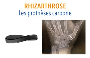 protheses-carbone_pouce_main_rhizarthrose_orthopedie_dr-dauplat_clinique-chirurgicale-du-libournais