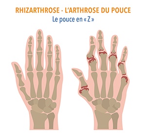 articulations_pouce_main_rhizarthrose_orthopedie_dr-dauplat_clinique-chirurgicale-du-libournais