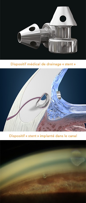dispositif medical de drainage_stent_clinique chirurgicale du libournais_chirurgie de la cataracte_docteur thomas darquies