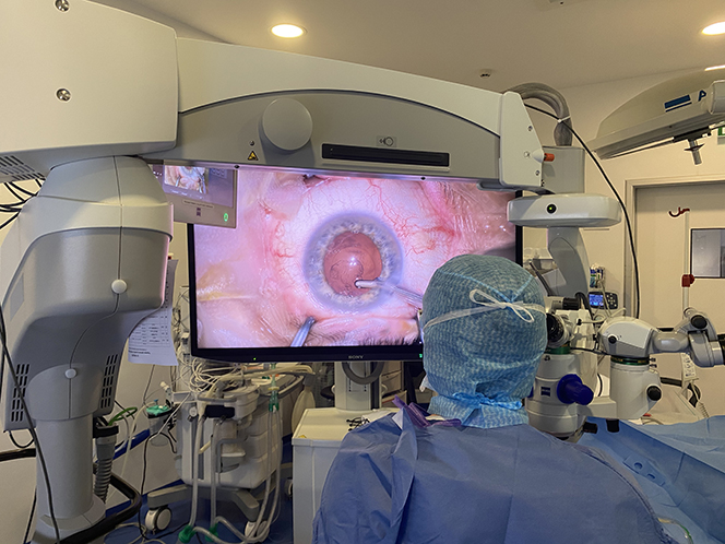 img chirurgie cataracte astigmatisme glaucome - docteur thomas darquies - chirurgien ophtalmologiste a la clinique chirurgicale du libournais #3