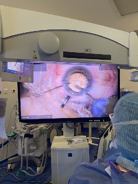 img chirurgie cataracte astigmatisme glaucome - docteur thomas darquies - chirurgien ophtalmologiste a la clinique chirurgicale du libournais - positionnement implant #1