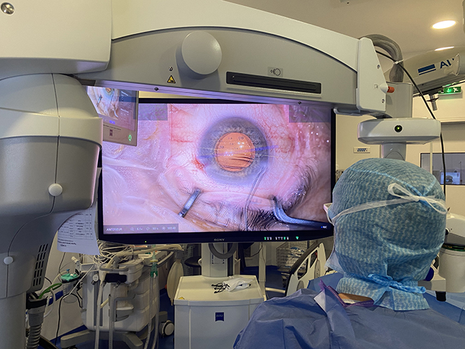img chirurgie cataracte astigmatisme glaucome - docteur thomas darquies - chirurgien ophtalmologiste a la clinique chirurgicale du libournais - positionnement implant #2